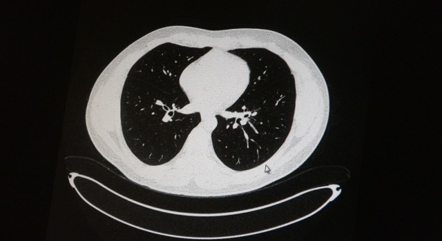 Aşılı ve aşısız olarak koronaya yakalanan 2 gencin akciğer tomografisi korkunç gerçeği gözler önüne serdi