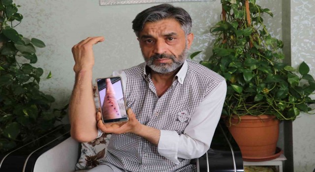 Elindeki şişlik için gittiği hastanede kolundan 2 kez yanlış ameliyat oldu iddiası