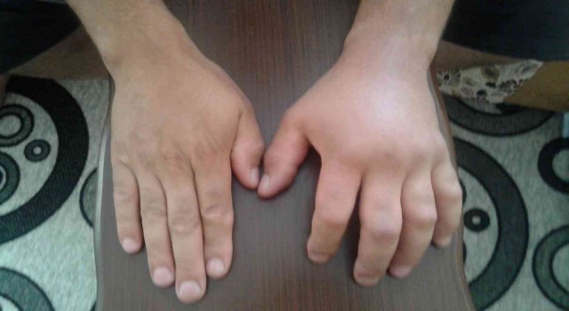 Türkiyede tanınmayan hastalık: Alerji mi Herediter Anjiyoödem mi