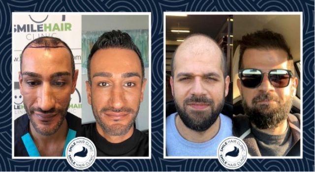 Saç Kökü Nedir?  Smile Hair Clinic