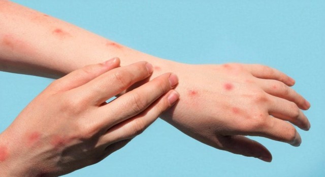 Maymun Çiçeği salgını Japonyaya sıçradı