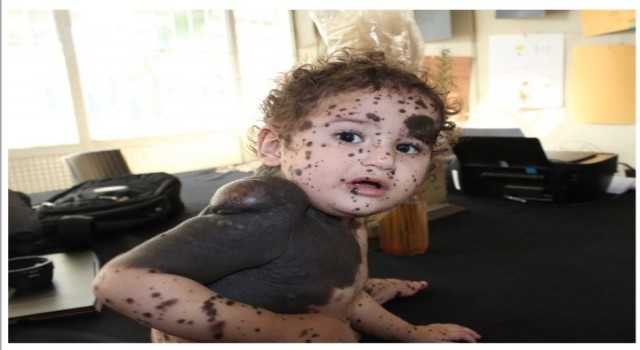 Vücudunda leke ve kitle ile doğan bebek tedavi ediliyor