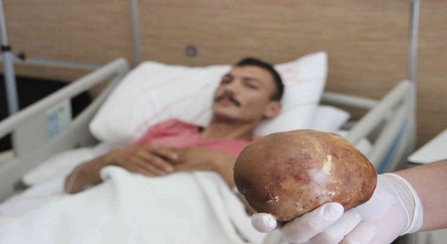 Hastaneye başvuran hastanın mesanesinden 1 kilo taş çıktı