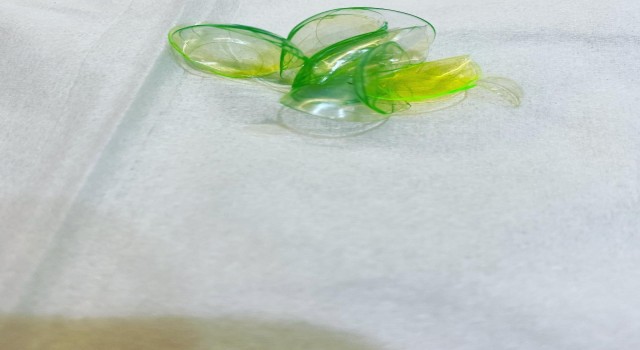 ABDde hastanın gözünden 23 kontakt lens çıkarıldı
