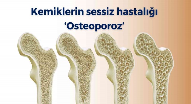 Kemiklerin sessiz hastalığı ‘osteoporoz