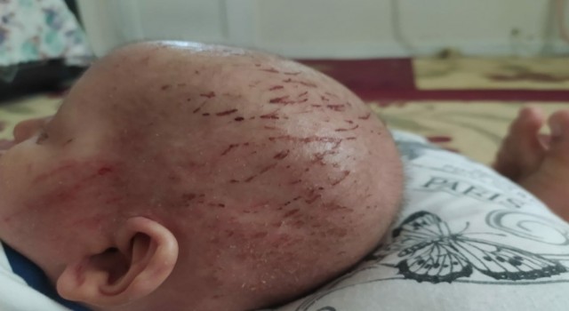 Balık pulu hastalığıyla yaşayan çocuğun hayatı kabusa döndü