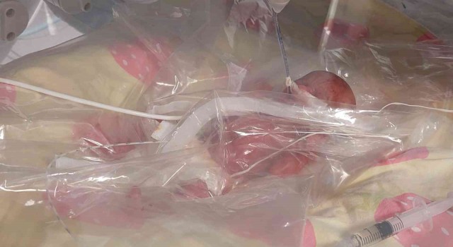 Tekirdağda 310 gramlık bebek doğdu