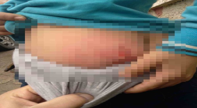 Batmanda köpeklerin saldırısına uğrayan çocuğun karnında derin yarıklar oluştu