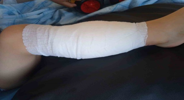 Pitpull cinsi köpeğin saldırdığı 5 yaşındaki çocuk hastanelik oldu