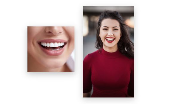 Hollywood Smile Yaptıran Ünlüler