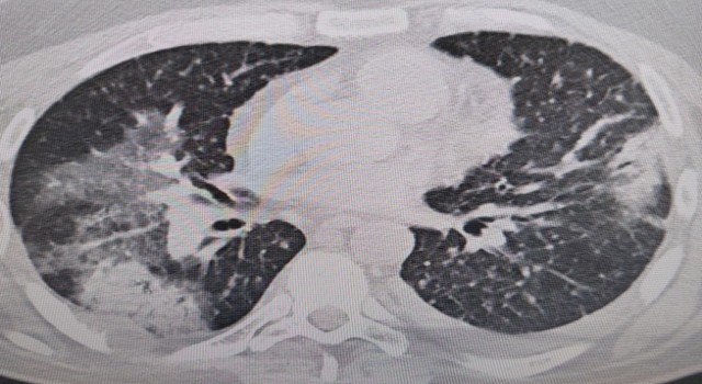 Klimaya bağlı “yaz zatürresine” dikkat