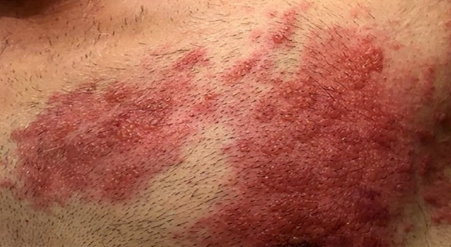 Covid-19 salgını sonrası viral hastalıklar coştu: Kızamık ve Zonaya dikkat