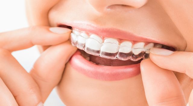 İnvisalign Tedavisi Mükemmel Bir Gülümseme İçin Yolculuk