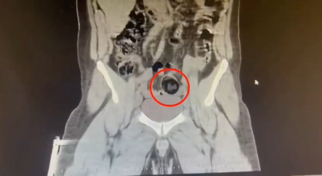 Karsta İranlı kuryenin makatından uyuşturucu çıktı