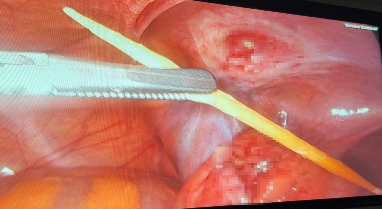 Sinopta 17 yaşındaki bir hastanın kalın bağırsağını delen kürdan kapalı yöntemle çıkarıldı