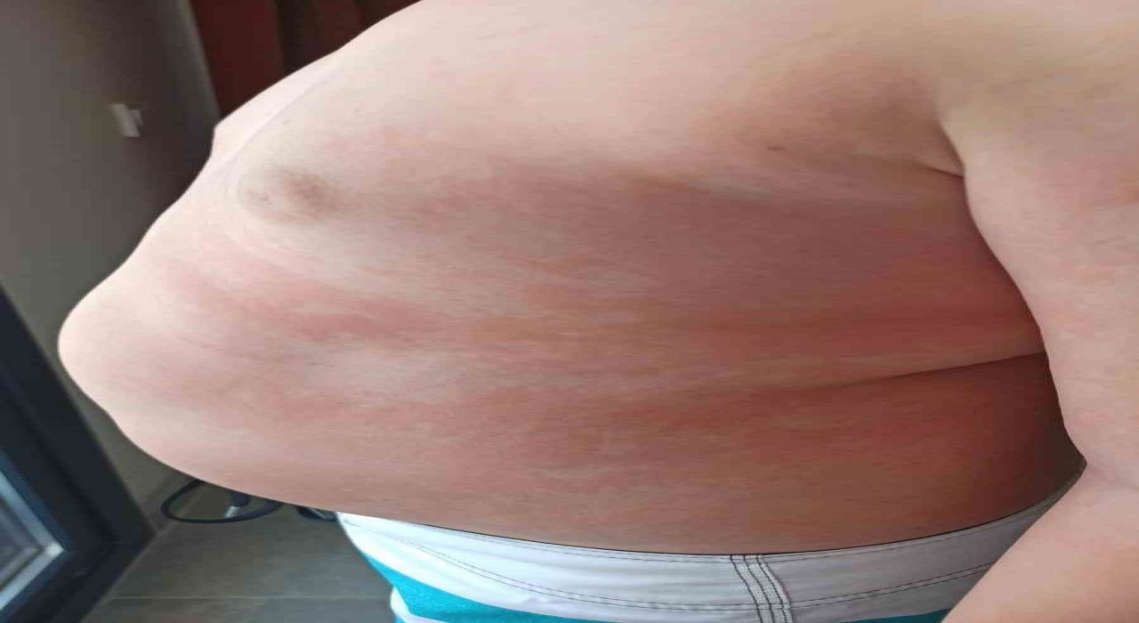 Çocuklarda besin alerjilerine dikkat: Yiyeceklerin içeriği sorgulanmalı, anafilaksi hayatı tehdit edebilir