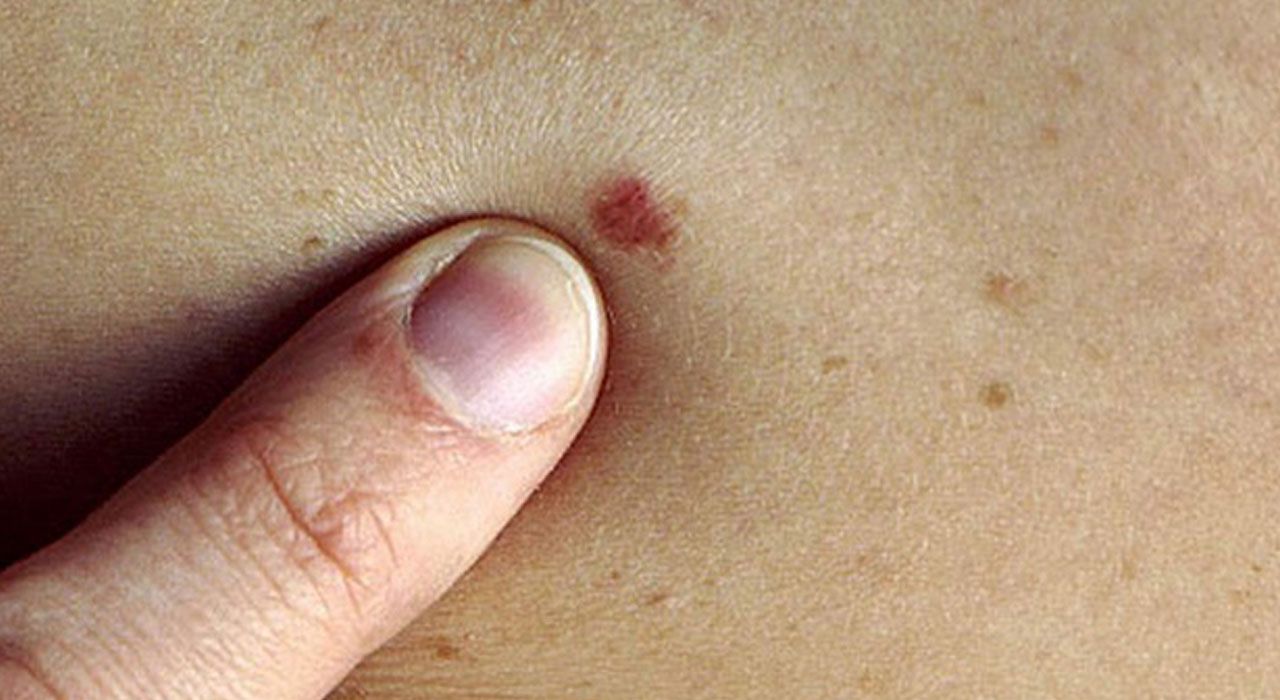 Osmaniye İl Sağlık Müdürlüğü’nden Cilt Kanseri Uyarısı