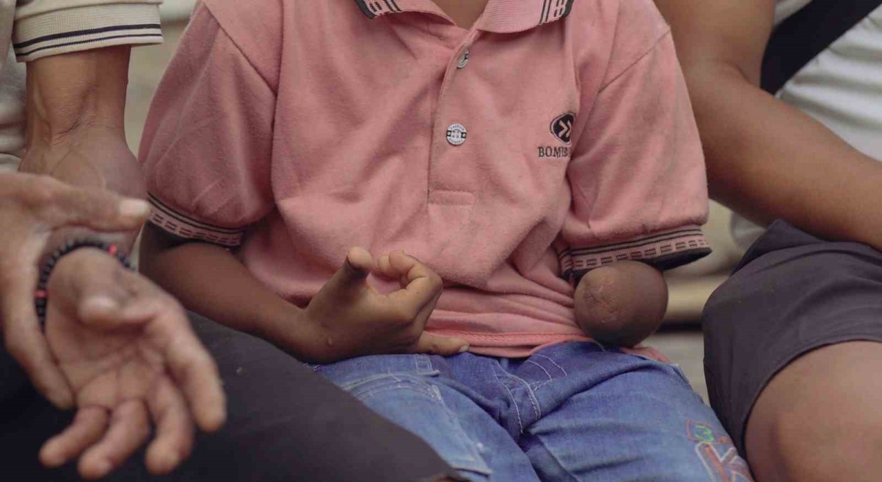 Türk belgesel ekibi komodo ejderinin saldırısında kolu ampute olan çocuğun tedavisini üstlenmek istiyor