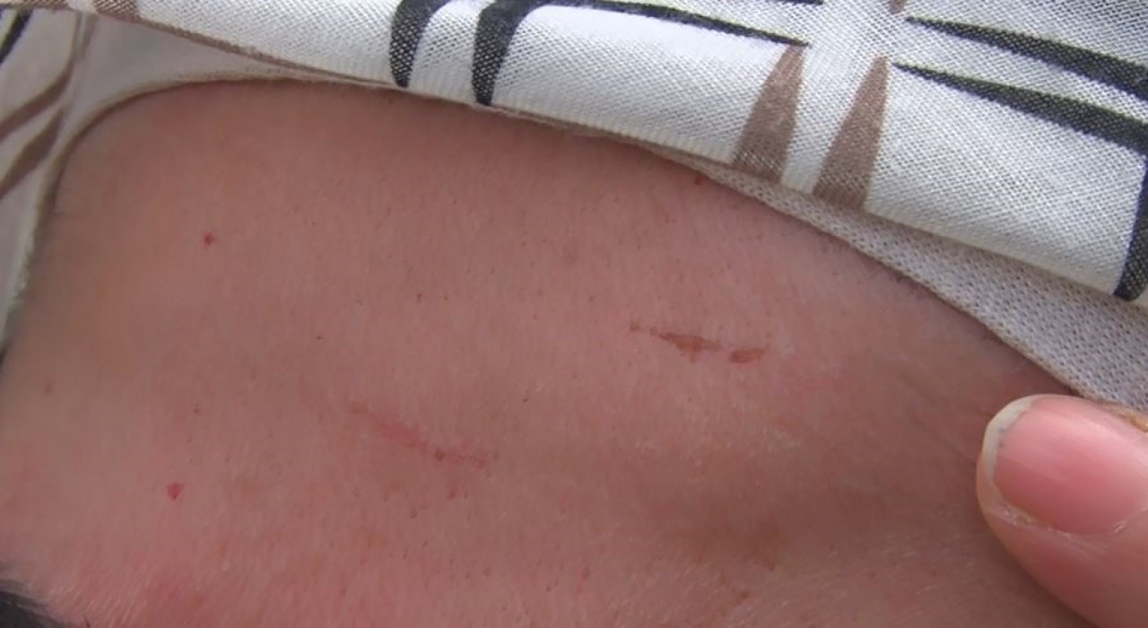 Çamaşırlarının üstüne çöp döktüğü komşunu önce dövdü sonra darp raporu aldı