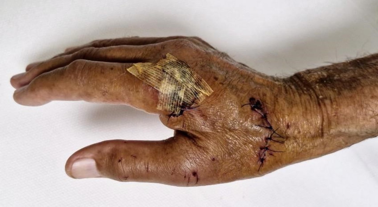 Duşakabin patladı, eline 20ye yakın dikiş atıldı