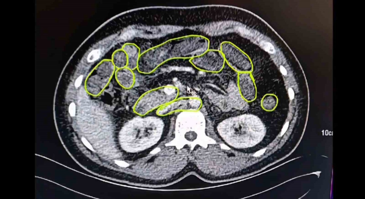 Mide ve bağırsaklarından uyuşturucu çıktı