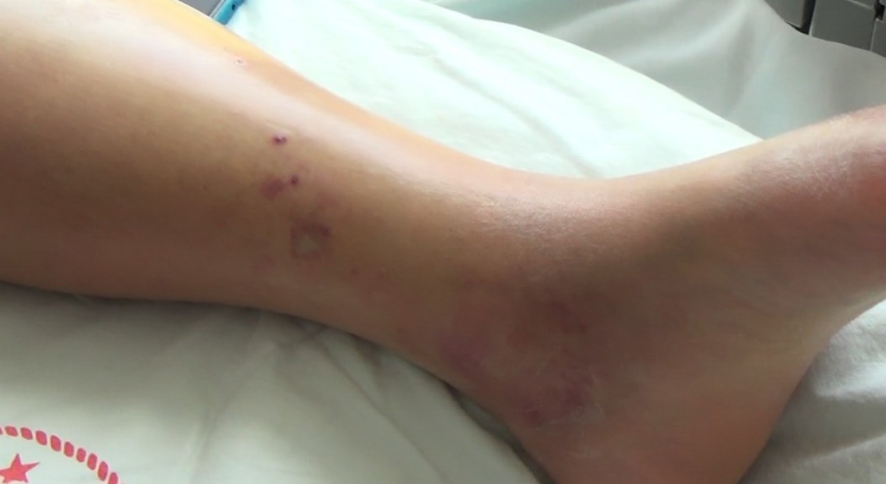 Tuncelide koca engerek yılanının ısırdığı kadın, tedavi altına alındı