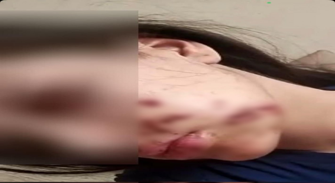 Yüzüne maytap isabet eden genç kız yaralandı