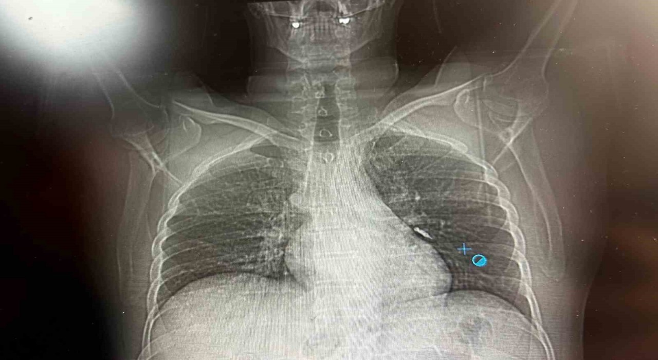İmplant vidası ciğerine kaçan hasta ölümden döndü