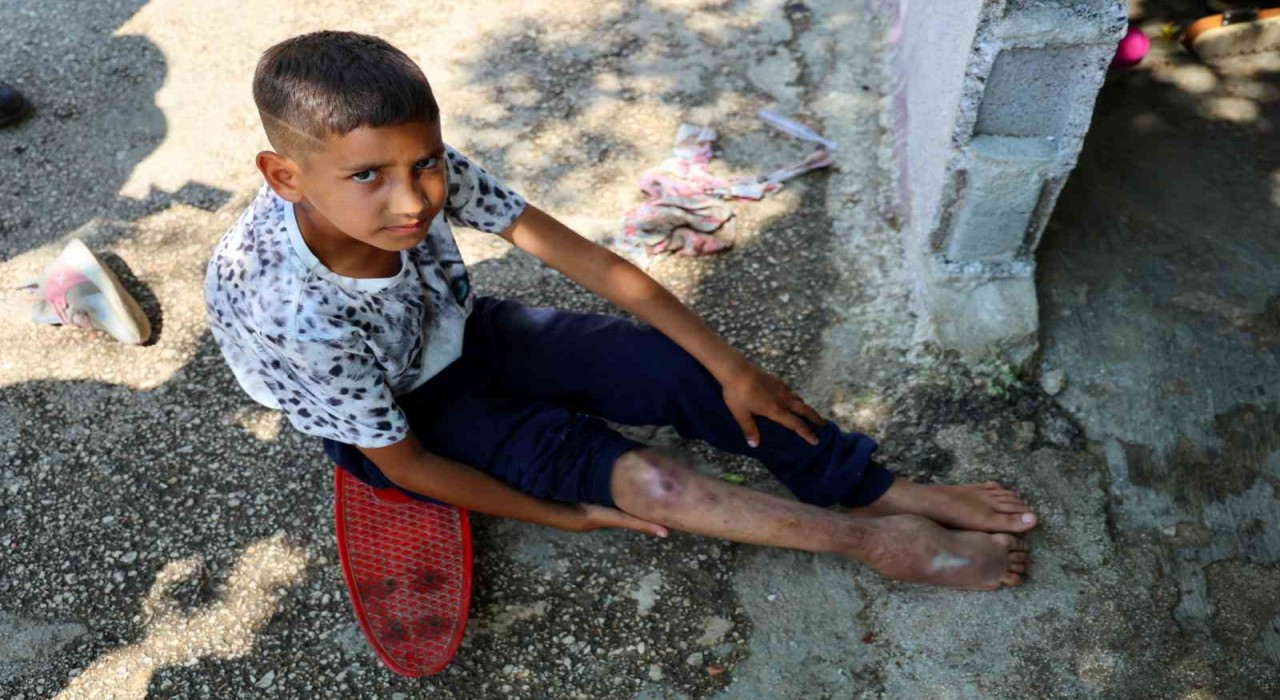 Kaza sonrası ayağı yanlış kaynadı, hayatı kaykay üzerinde geçiyor