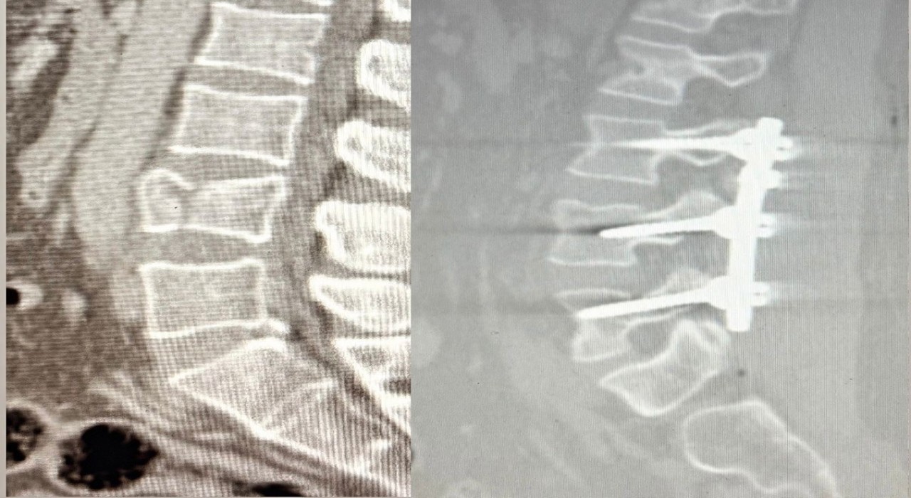 Yüksekten düşen hasta, Patnosta ilk kez uygulanan ameliyatla ayağa kalktı