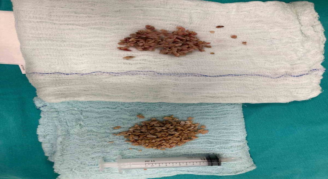 Bayburtta 84 yaşındaki hastanın mesane taşları kapalı yöntemle çıkarıldı