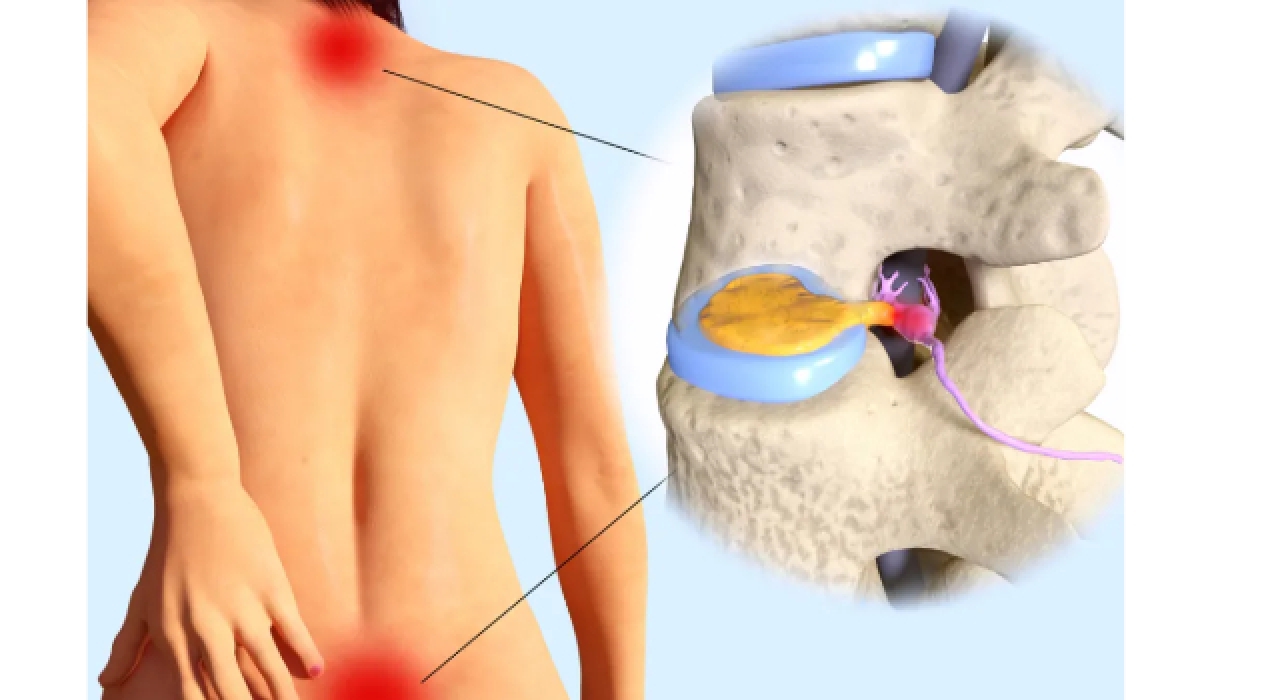 Bel ve Boyun Fıtığında Nükleoplastinin Yeri: Op. Dr. Murat Karakuş ile Akıllı Tedavi Rehberi