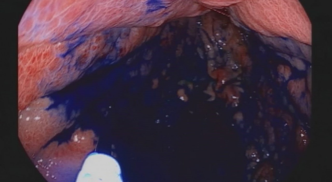 Boyama yöntemi ile mide ve bağırsak kanserinde erken teşhis