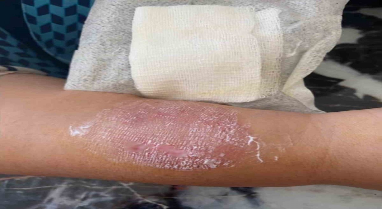 Büyükçekmecede sigara dumanı tartışmasında kolunu ısırdı