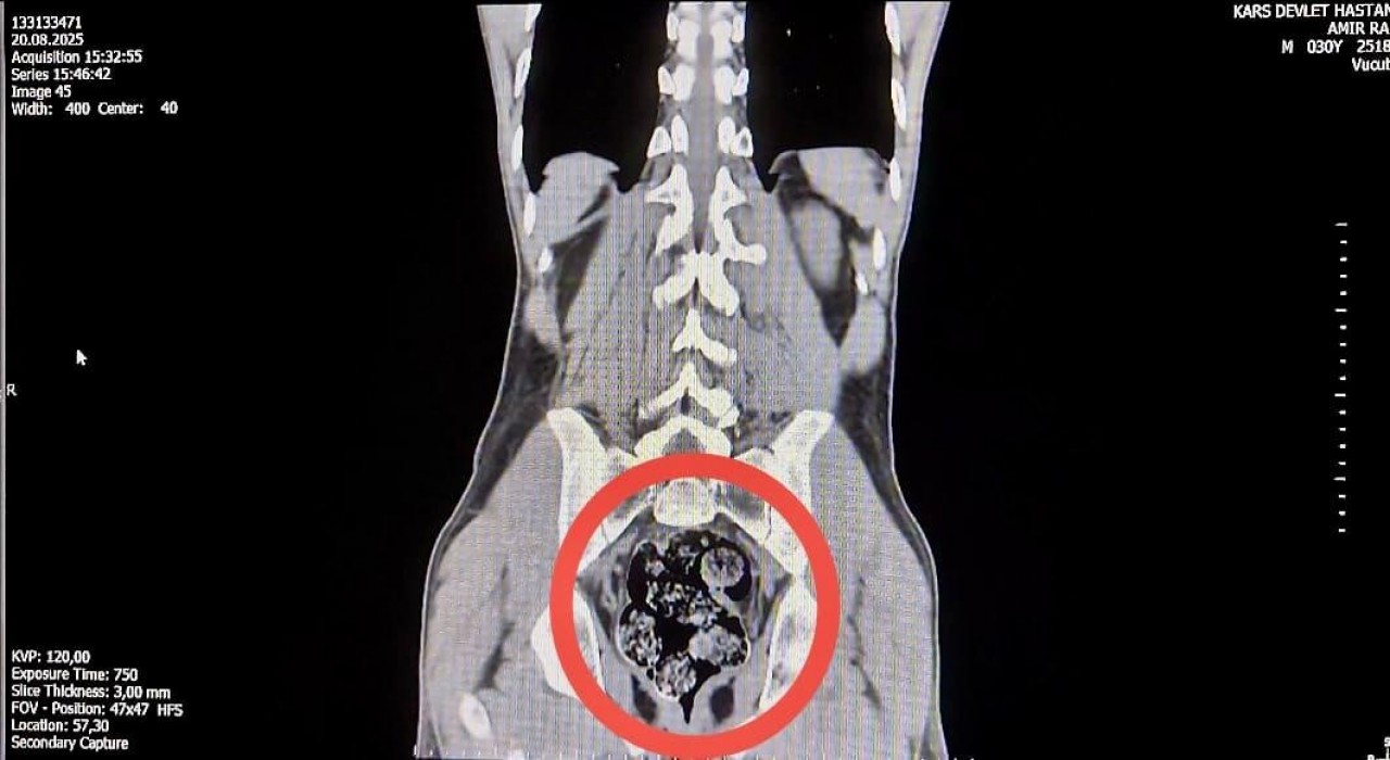Karsta İranlı kuryenin makatından uyuşturucu çıktı