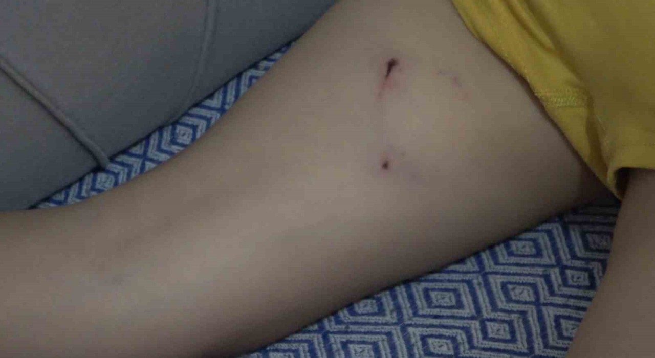 Rizede 5 yaşındaki çocuk, sokak köpeğinin saldırısına uğradı