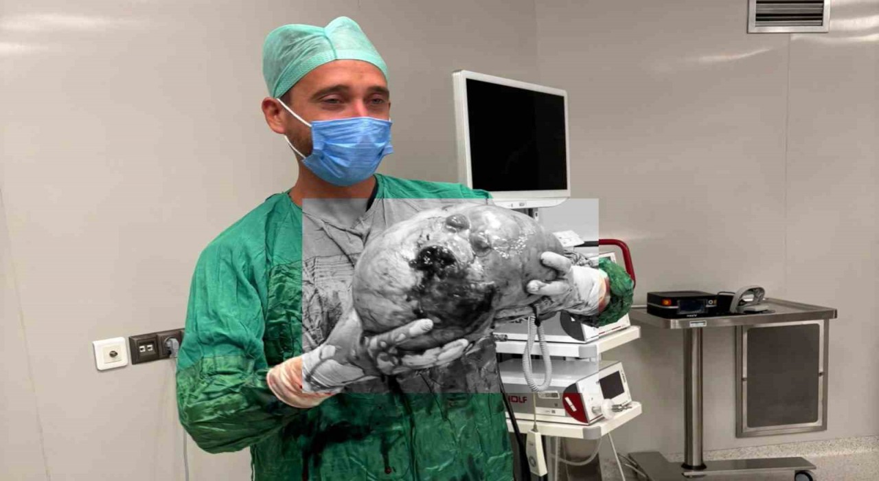 Yozgatta bir hastadan karpuz büyüklüğünde kitle çıkartıldı