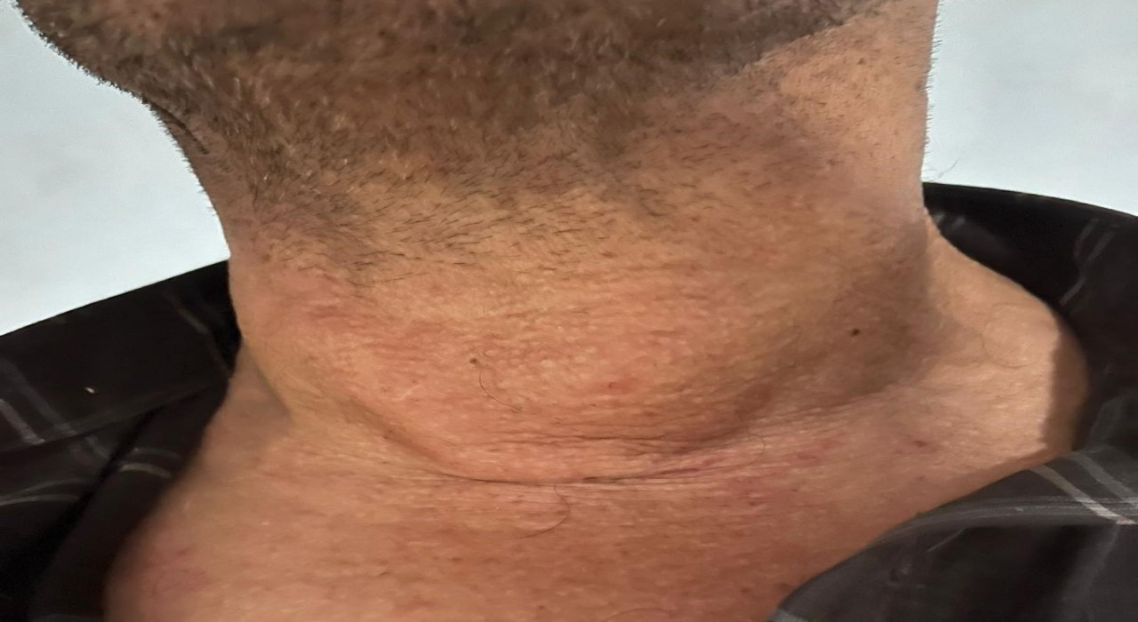 Kütahyada dev guatr ameliyatsız tedavi edildi: Yüzde 90dan fazla küçülme oldu