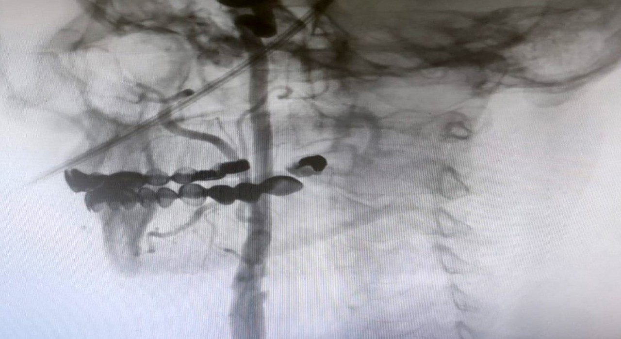 Manisa Şehir Hastanesinde felç riskine karşı ameliyatsız çözüm