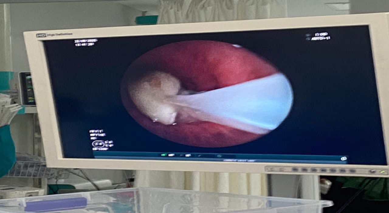 Nefes Borusuna Kaçan Sarımsak Ameliyatla Çıkartıldı