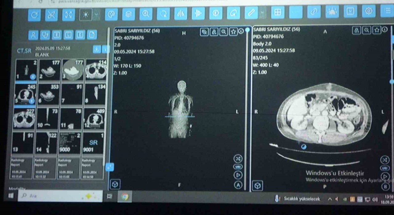 Vandan dünyaya örnek çalışma: Kanser tedavisinde yapay zekâ kullanıldı