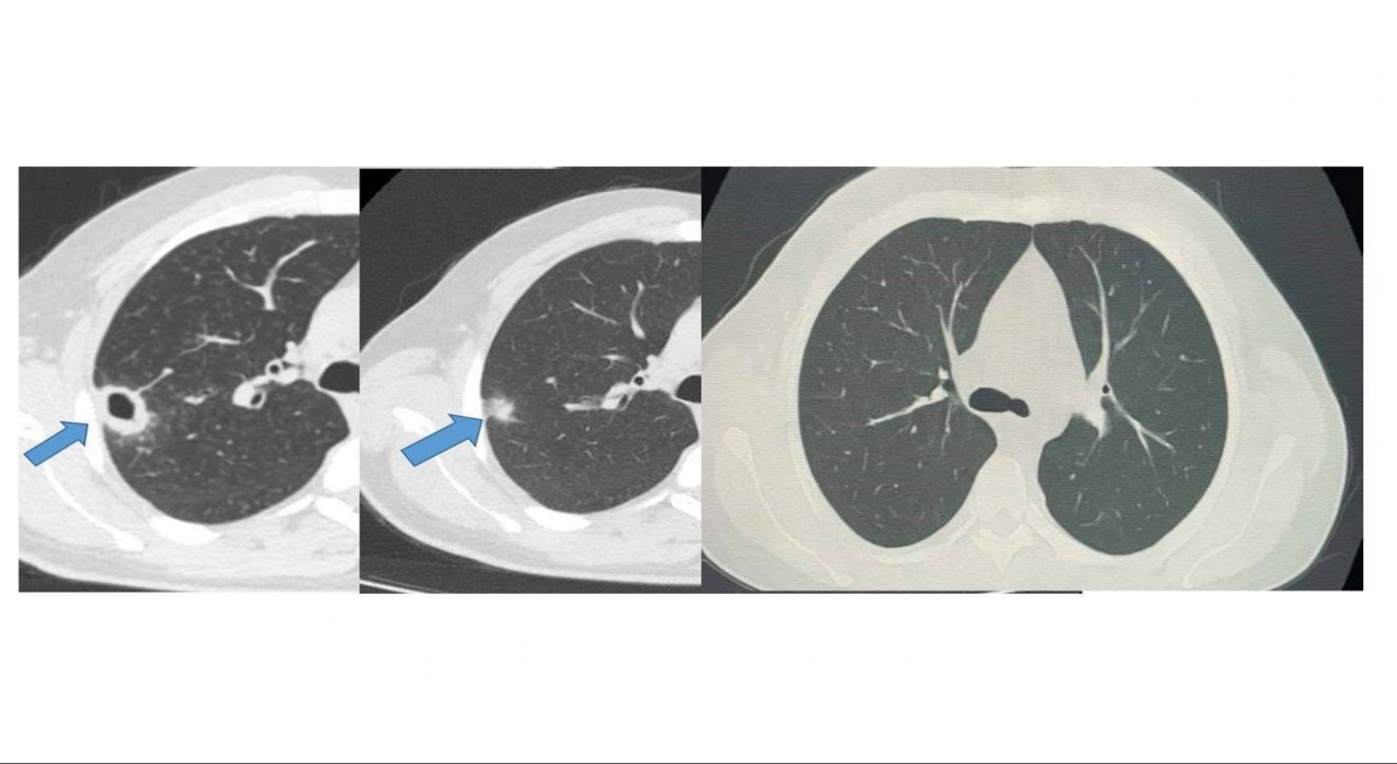 Bayburtta 50 yaşındaki hasta erken tanıyla sağlığına kavuştu