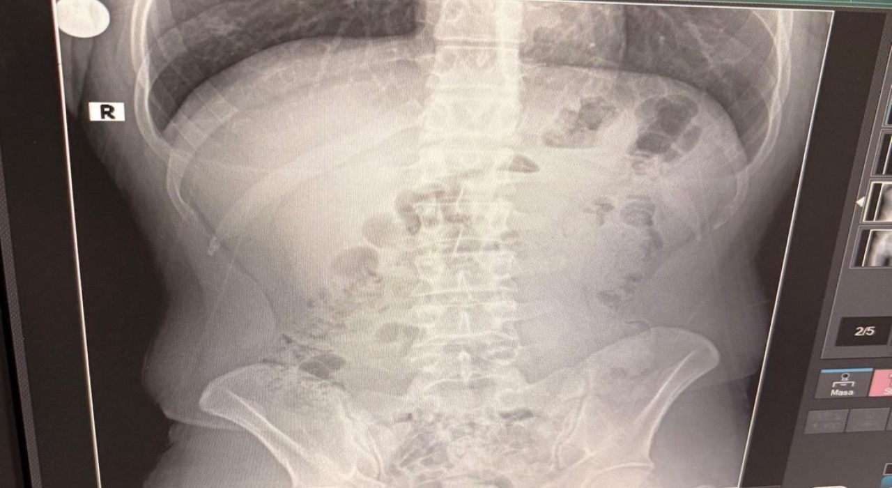 Uşakta midelerinden uyuşturucu çıktı: İranlı 3 kişi tutuklandı