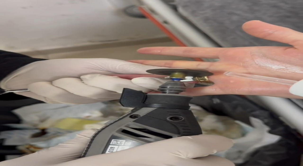 Batmanda parmağa sıkışan iki yüzük spiral makine ile çıkarıldı