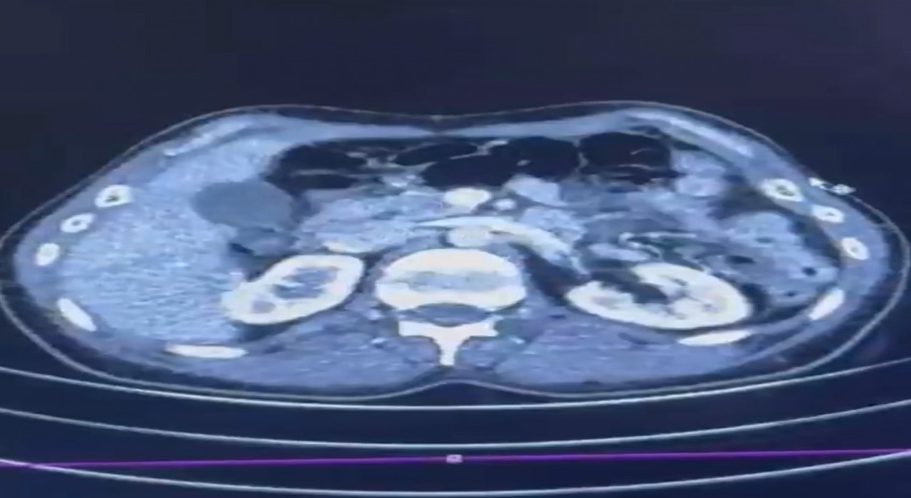 Ülkeye midelerinde uyuşturucu getiren şahıslar yakalandı