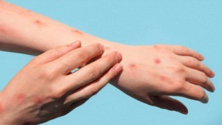 Maymun Çiçeği salgını Japonyaya sıçradı