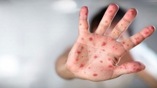 Maymun Çiçeği hastalığını 1 saatte saptayabilen PCR Tanı Kiti geliştirildi