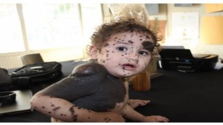 Vücudunda leke ve kitle ile doğan bebek tedavi ediliyor