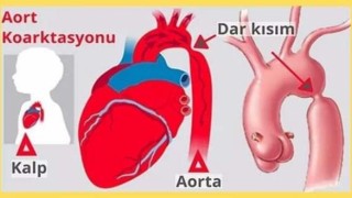 Bandırmada ilk kez aort koarktasyon ameliyatı yapıldı