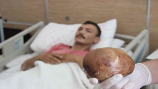 Hastaneye başvuran hastanın mesanesinden 1 kilo taş çıktı